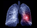 PULMONARY EMBOLISM+DVT